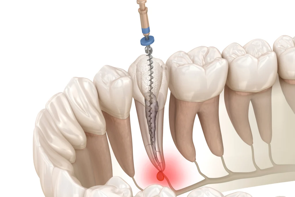 retraitement endodontique castelnau le lez retraitement endodontique castelnau le lez Endodontie Eurêka dentaire - Chirurgiens-dentistes à Castelnau-le-Lez