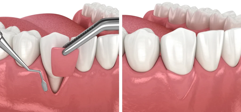 greffe gencives parodontologie chirurgicale Chirurgie orale Eurêka dentaire - Chirurgiens-dentistes à Castelnau-le-Lez