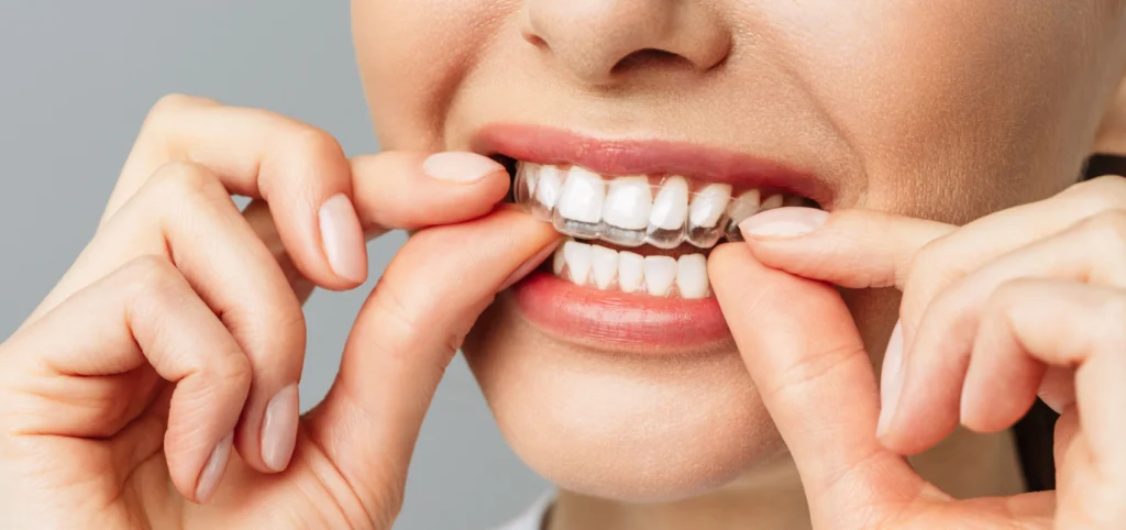 gouttiere invisible Orthodontie Eurêka dentaire - Chirurgiens-dentistes à Castelnau-le-Lez