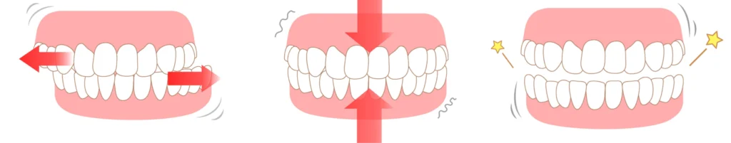 bruxisme dentaire Le bruxisme Eurêka dentaire - Chirurgiens-dentistes à Castelnau-le-Lez