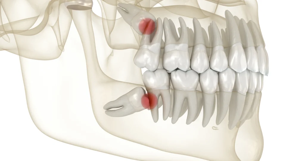 dents sagesse extraction Chirurgie orale Eurêka dentaire - Chirurgiens-dentistes à Castelnau-le-Lez