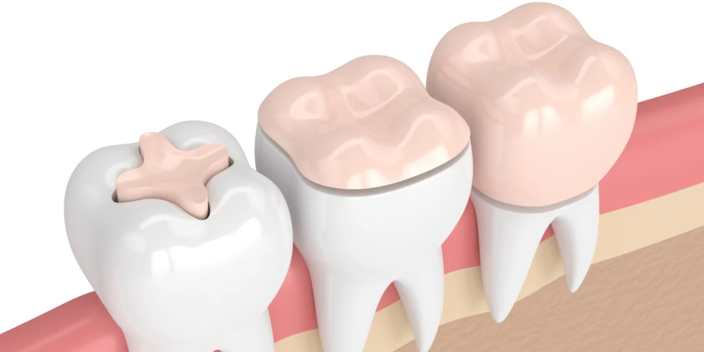 inlay onlay overlay Chirurgie orale Eurêka dentaire - Chirurgiens-dentistes à Castelnau-le-Lez