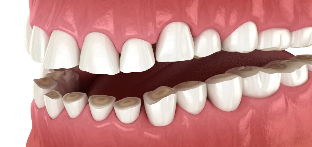 usures dentaires L’usure dentaire Eurêka dentaire - Chirurgiens-dentistes à Castelnau-le-Lez