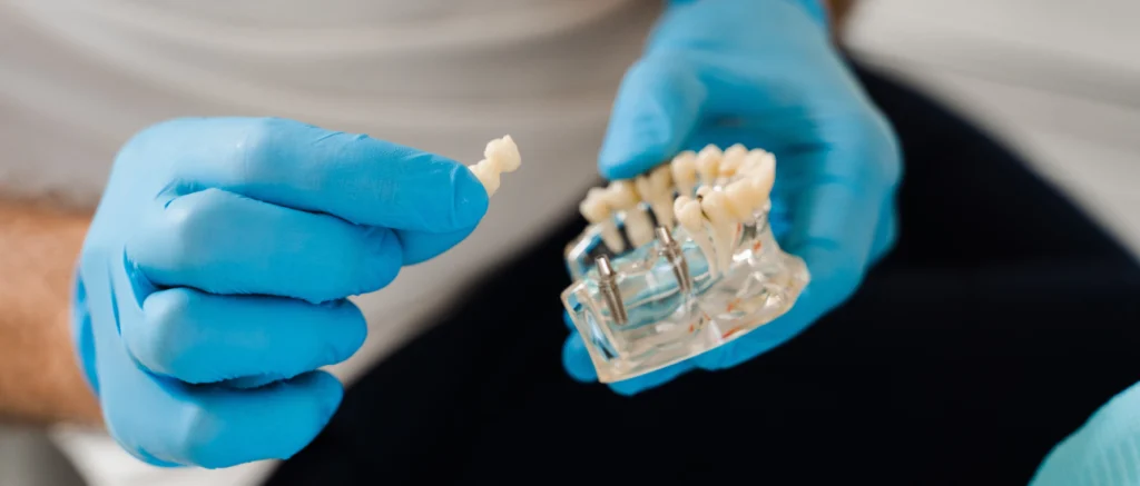 implant dentaire cres Dentiste à Le Crès : implants dentaires Eurêka dentaire - Chirurgiens-dentistes à Castelnau-le-Lez