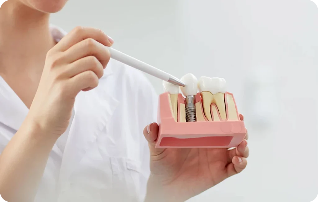 implant dentaire montpellier eureka Dentiste à Montpellier : implants dentaires Eurêka dentaire - Chirurgiens-dentistes à Castelnau-le-Lez