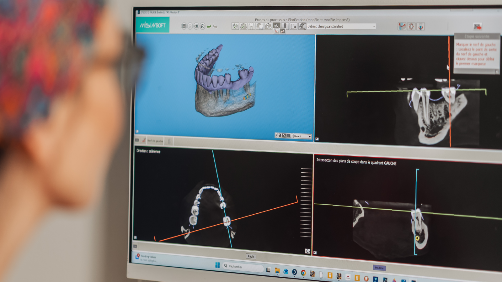 implant dentaire remplacement dentaire
