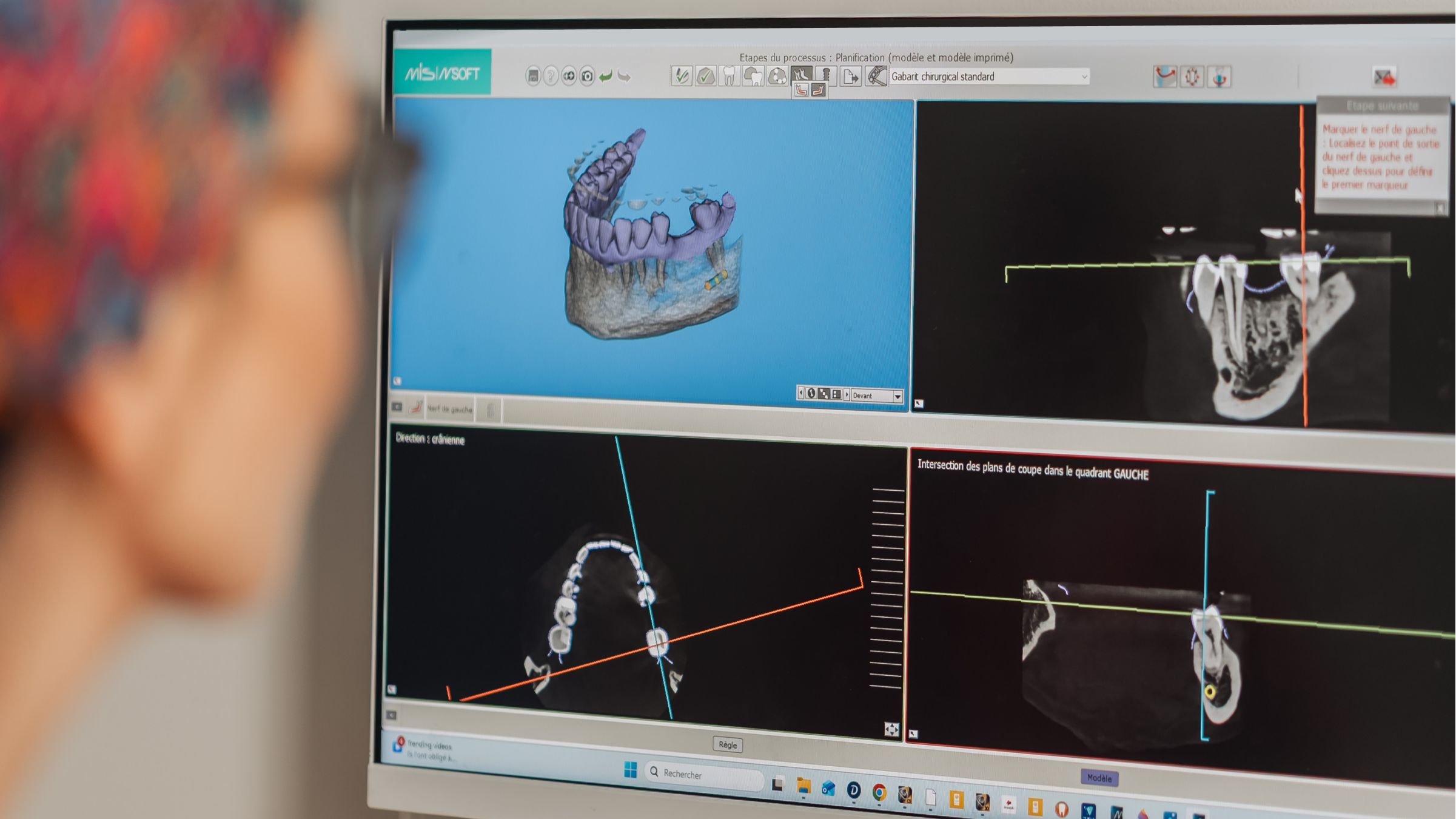 implant-dentaire-remplacement-dent-montpellier